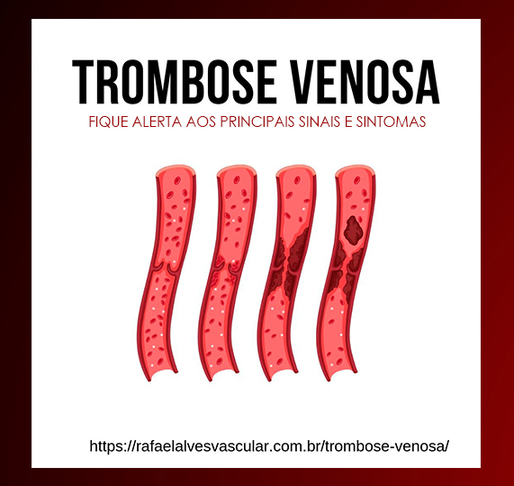 Trombose x anticoncepcional: por que esta é uma relação perigosa