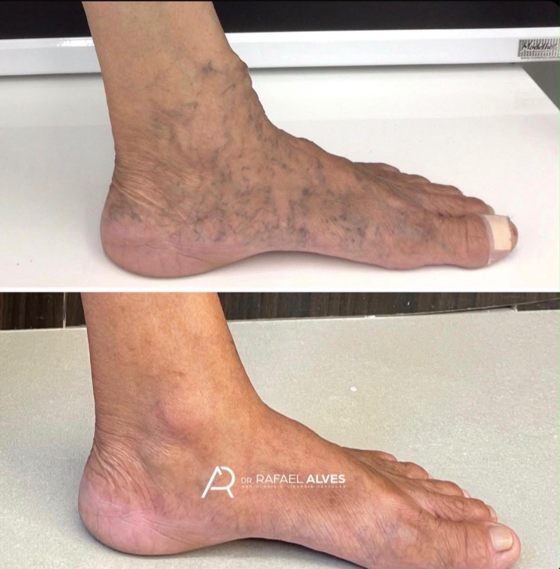 Resultado em tratamento vascular no pé