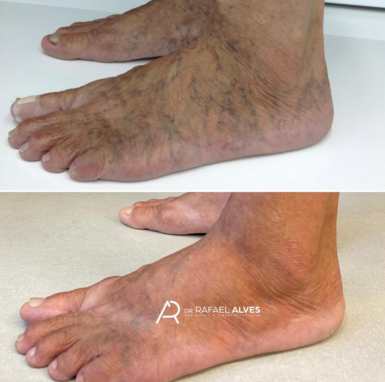 Resultado vascular em região do pé